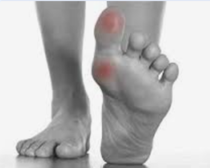 GOUT