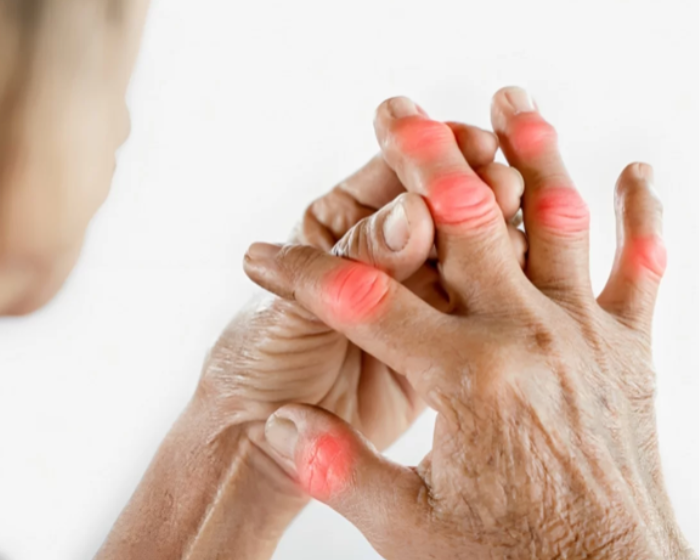 ARTRITIS RHEUMATOID