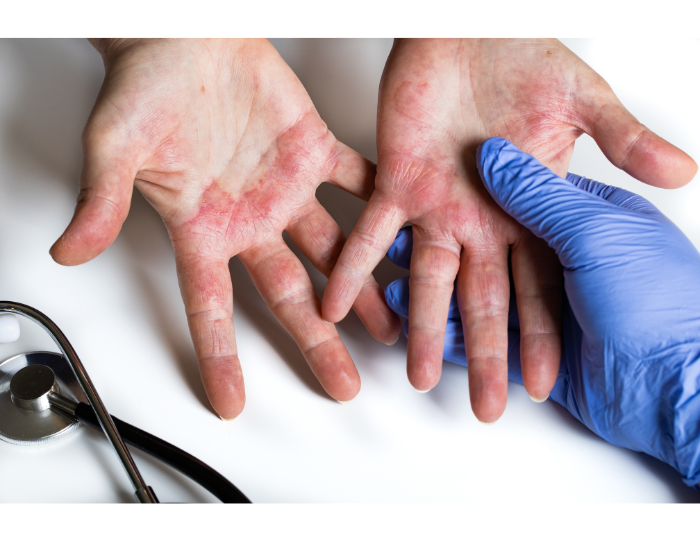 ATOPIC DERMATITIS